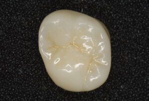 What type of crown should you choose?