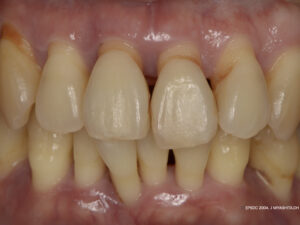 Preventing Periodontal Disease from a Young Age — Home Care and Expert Advice for Your 30s and Beyond