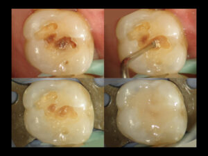 むし歯はどう取り除くのがいいの？How should we remove the carious lesion?