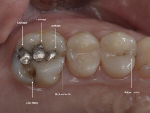 The Truth About Dental Diagnosis: Why Precise Examinations Are Necessary Even When There’s No Pain?