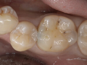 Drill or Preserve? How the Latest “Caries Diagnosis” Teaches You to Protect Your Teeth for a Lifetime.