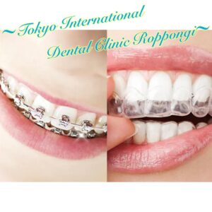 アライナー矯正・Aligner tooth alignment treatment